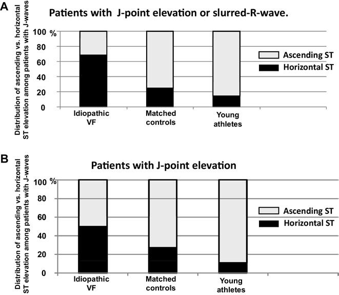 228 Heart Rhythm, Vol 9, No 2, February 2012 Figure 3 Distribution of patients with early repolarization according to the morphology of their ST segment.