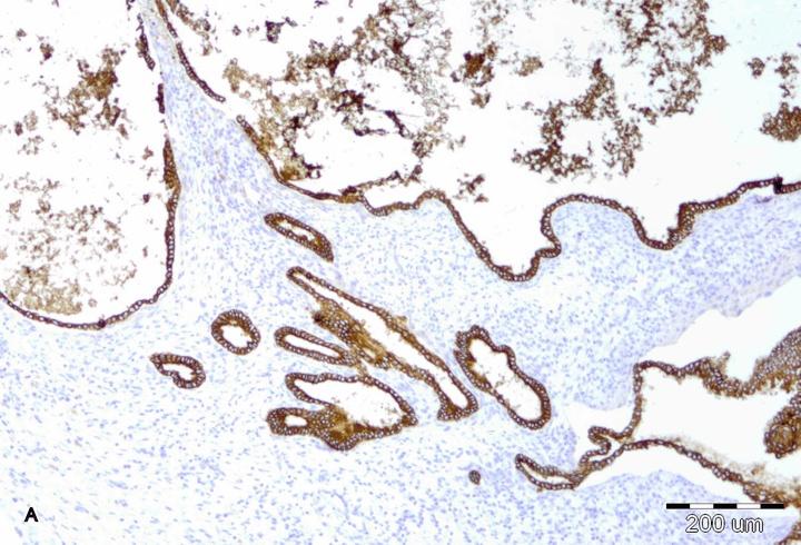 Figure 3: A) Cuboidal biliary epithelium lining ectatic ducts (CK19, x40), B) numerous ductal plate remnants