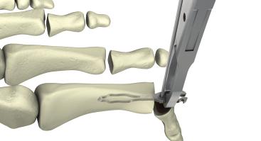 Toe from its support with the forceps (XPI003001).