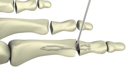 Step 5 Manually reduce middle phalanx over the distal legs of the implant.