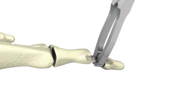 Insert the distal part into P3 until the forceps come into contact with P3. Continue to hold the forceps closed.