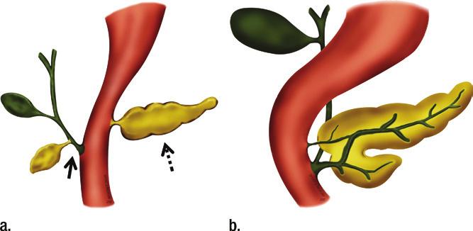 Figure 1 Figure 3 Figure 2 Figure 1: Schematic of pancreatic development. (a) Early development of the ventral (solid arrow) and dorsal buds (dashed arrow) prior to rotation.