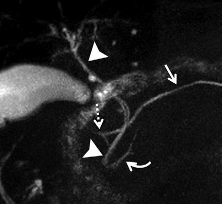 Angled coronal fat-suppressed half-fourier acquisition single-shot turbo spin-echo (repetition time msec/echo time msec, 9450/740; 40-mm section thickness; 30-cm field of view) MR image shows the
