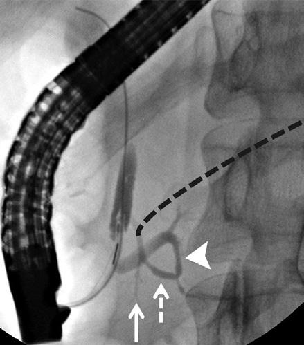 Focal dilatation of the main pancreatic duct (dashed arrow) with pooling of contrast material in the dependent portion is also present.