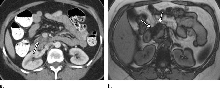 Axial portal venous phase multidetector CT scan through the body region of the pancreas reveals low-attenuating fat replacing the body, neck, and tail, with strands of acinar tissue and ductal