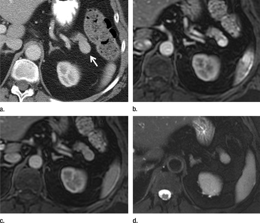 Portal venous phase multidetector CT scan obtained to evaluate generalized abdominal pain shows cirrhotic liver contour and prominent node anterior to the common hepatic artery (arrow), mimicking a