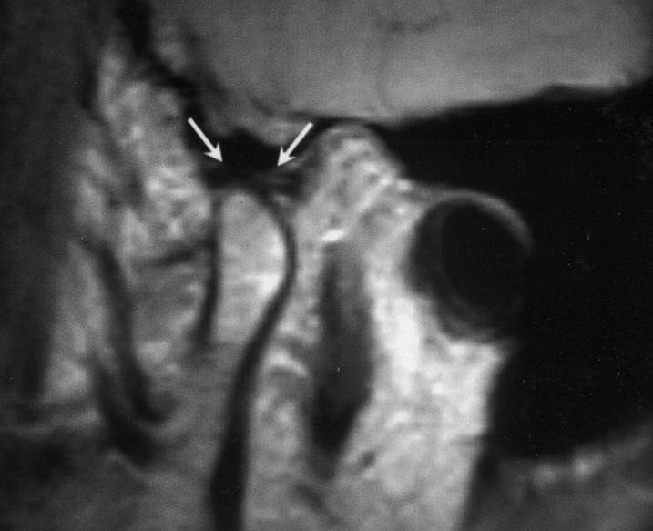 Sonography and MR Imaging of the Temporomandibular Joint A B C Fig. 2. Temporomandibular joint (TMJ) of 32-year-old woman.