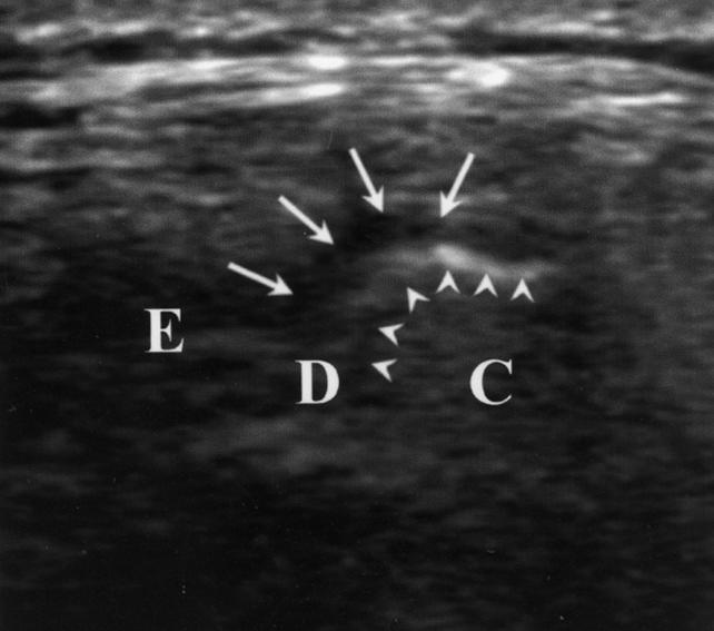 A, Longitudinal high-resolution sonogram obtained in closed-mouth position shows anterosuperior TMJ compartment and disk (arrows) anterior to condyle (arrowheads).