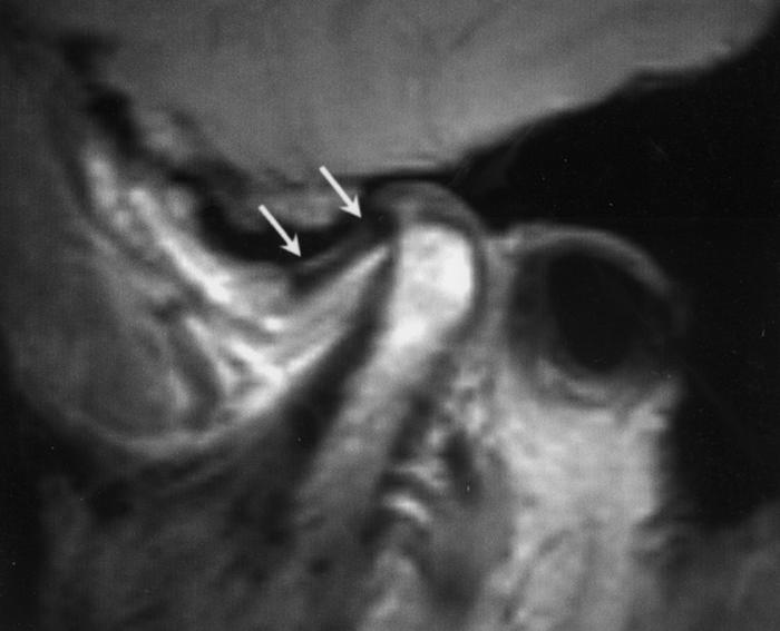 C, Longitudinal high-resolution sonogram obtained in maximal open-mouth position shows anterosuperior TMJ compartment and disk (arrows) superior to condyle (arrowheads).