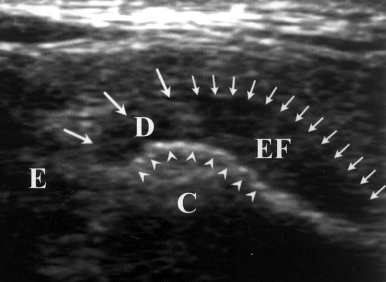 Longitudinal high-resolution sonogram shows anterosuperior TMJ compartment with disk disrupted in posterior (large arrows) and anterior (small arrows) parts.