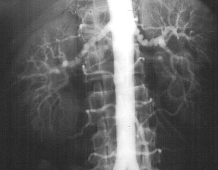 FMD: MEDIAL FIBROPLASIA Aneurysms (string of beads) larger than anticipated artery