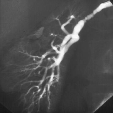 FMD: PERIMEDIAL FIBROPLASIA Aneurysms (string of beads) smaller than anticipated artery