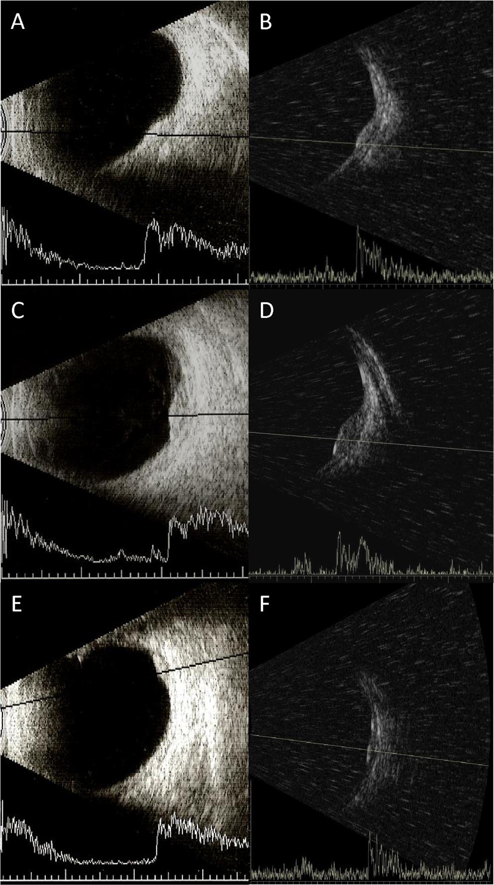 2008 Graefes Arch Clin Exp Ophthalmol (2014) 252:2005 2011 Fig. 2 Examples of ultrasonography in SCMT. Case 18 (a and b), case 25 (c and d) and case 31 (e and f).