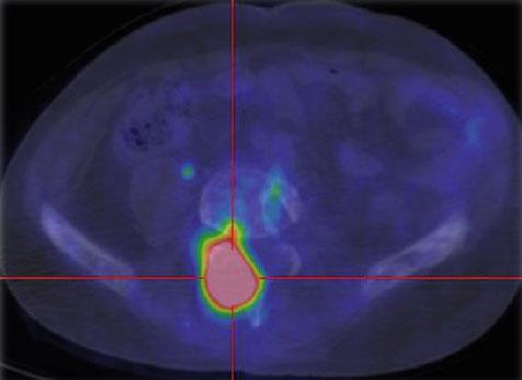 1 FDG PET/CT demonstrated several positive