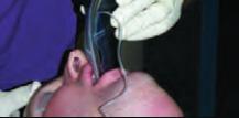 The ease of intubation was graded as Grade I: No manipulation of the larynx was required, Grade II: External manipulation was necessary to intubate, Grade III: Intubation possible only with a stylet
