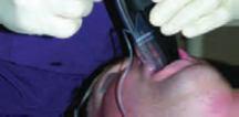 D The ETT separated from the Airtraq Laryngoscope by pulling the Airtraq laterally while holding the ETT in