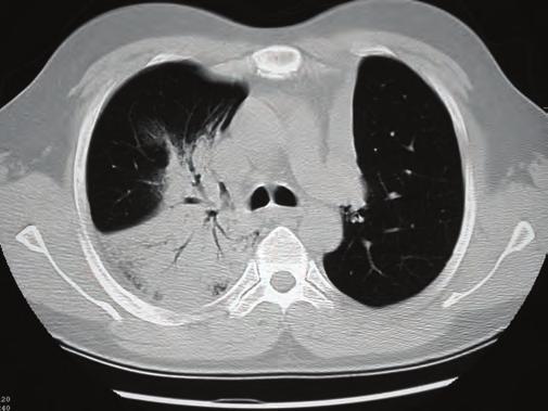 Figure e40-2 Computed tomography of the chest in two patients with granulomatosis with polyangiitis