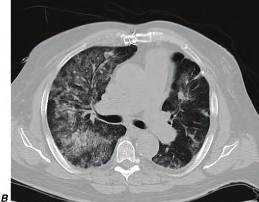 Collapse of the left upper lobe secondary to endobronchial stenosis from granulomatosis with