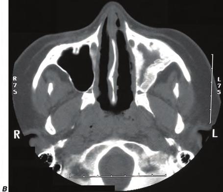 Figure e40-6 Computed tomography of the sinuses in two patients with granulomatosis with