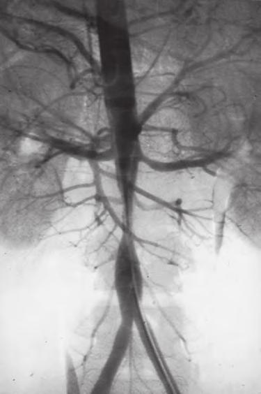 Figure e40-13 Arteriogram demonstrating stenosis of the abdominal aorta in a 25-year-old female with