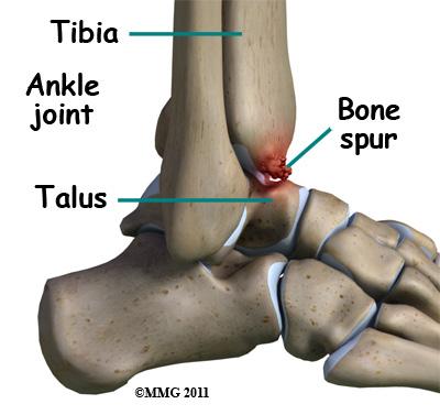 The deltoid ligament can be torn, but it is usually torn in a combination of injuries when the ankle is broken; it is uncommon to injure the deltoid ligament alone.