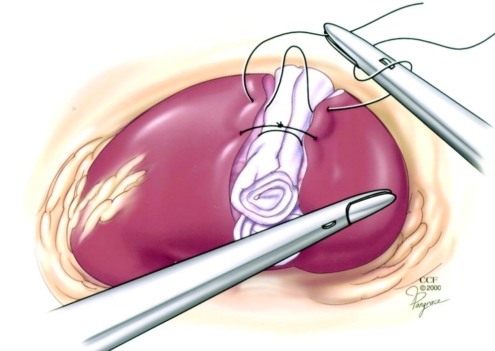 LAPAROSCOPIC PARTIAL NEPHRECTOMY (Figure-3), a Hem-o-Lok clip (Weck Closure System, Research Triangle Park, NC) is secured on the suture to prevent it from pulling through, and FloSeal (Baxter,