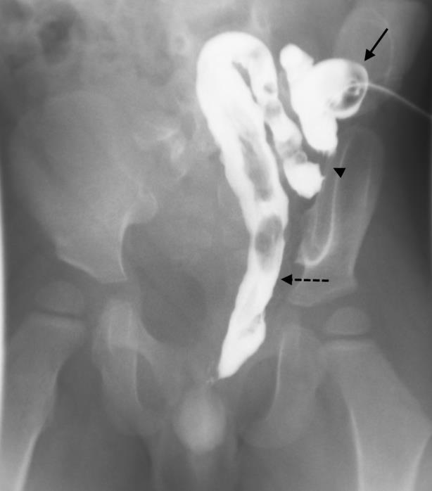 5 Tesla GE Scanner. FINDINGS: Sagittal T2-weighted image shows the bladder (arrow) being displaced anteriorly and superiorly by the anterior meningocele (*).