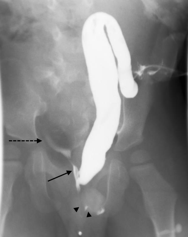 TECHNIQUE: T2 FSE Saggital, TE 82, TR 4000, slice thickness 4 mm Figure 4: 2-year-old male with an anorectal malformation and large anterior sacral meningocele.