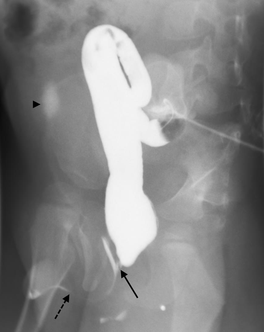 Figure 6 (left): 2-year-old male with an anorectal malformation and large anterior sacral meningocele.