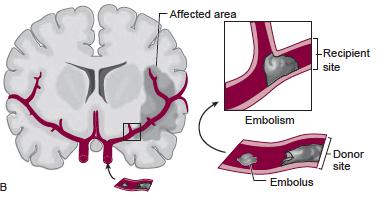 Ischemic Stroke Mechanisms Embolism Material formed elsewhere, typically from a proximal donor source, within the vascular system lodges in a recipient artery and blocks blood flow Cardiac source,