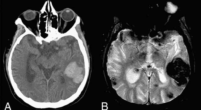 Acute Stroke Neuroimaging For acute hemorrhage accuracy of MRI (GRE