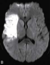 Acute Stroke Neuroimaging Imaging of the early ischemic changes: CT or MRI Non-contrast CT (within 6-8 hour) Specificity: 56-100%