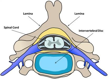 Pediculectomy Dorsal laminectomy Ventral slot Fenestration An illustration of the normal cross-sectional anatomy