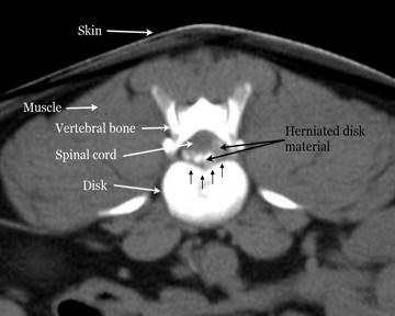 A typical CT scan cross sectional image of a patient with intervertebral disc disease Magnetic