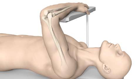 Operative Technique Olecranon Patient Positioning: For isolated Olecranon fractures the patient is positioned supine with the arm placed over