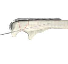 Reduction clamps are provided to facilitate reduction. The fracture is then provisionally stabilized in an anatomic position using K-wires.
