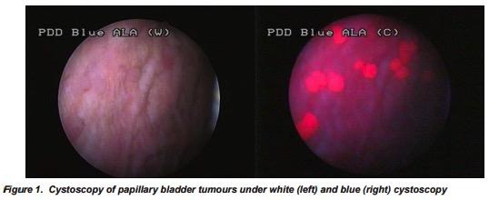GUIDELINE: ENHANCED CYSTOSCOPY 30.In a patient with NMIBC, a clinician should offer blue light cystoscopy at the time of TURBT, if available, to increase detection and decrease recurrence.