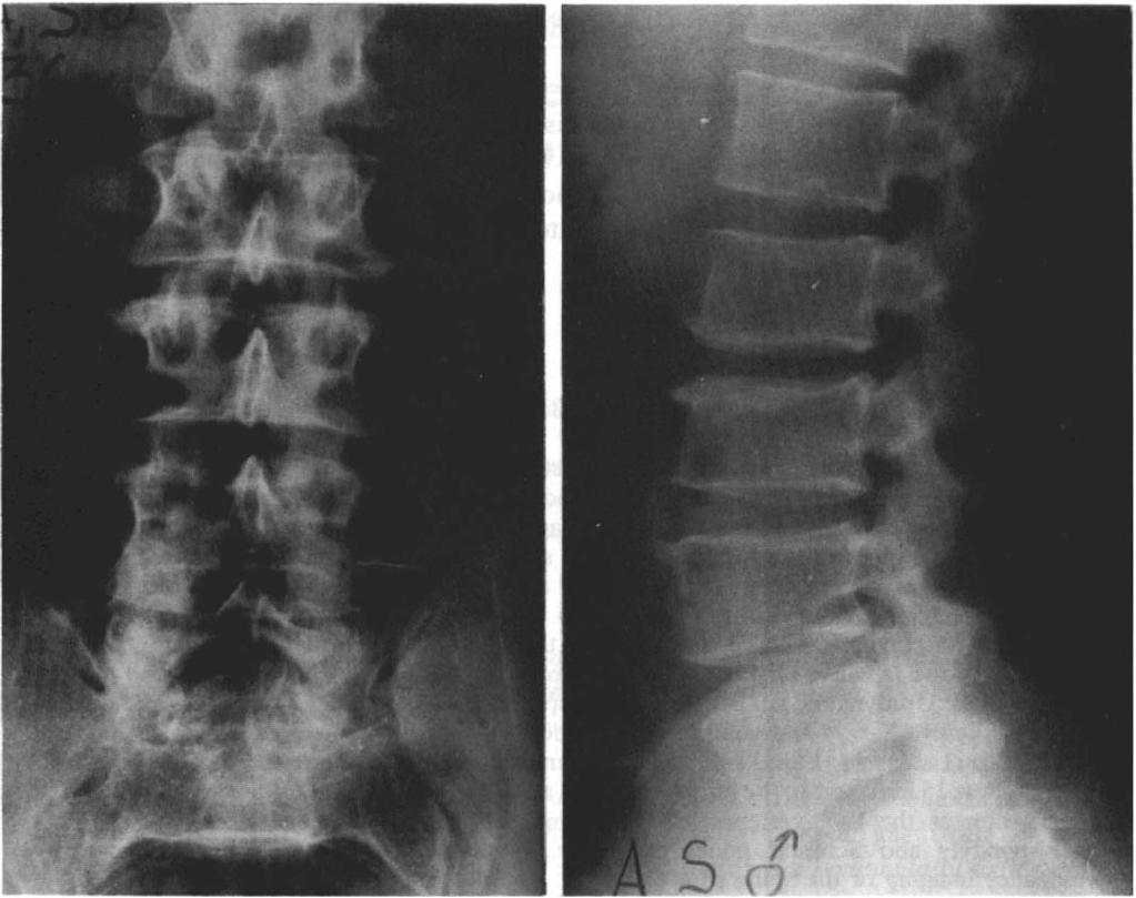 352 PARAPLEGIA Figure 2 Lumbar spine X-rays