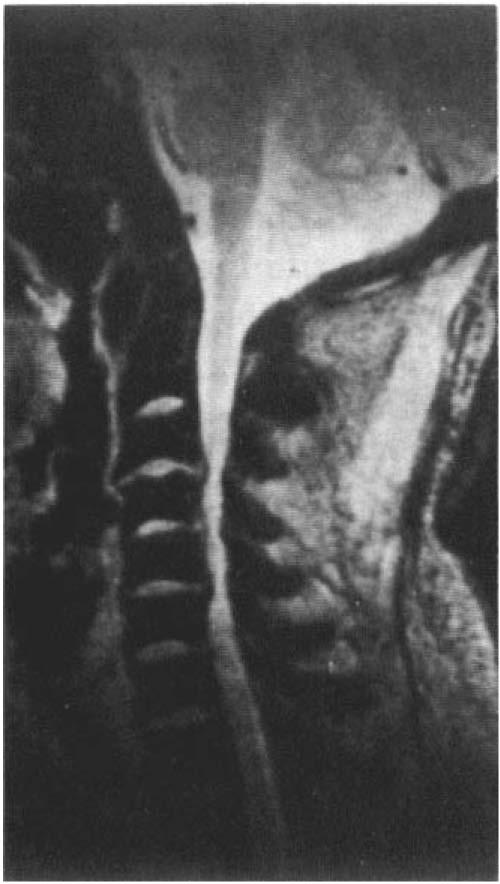 Figure 3 severe cord atrophy.