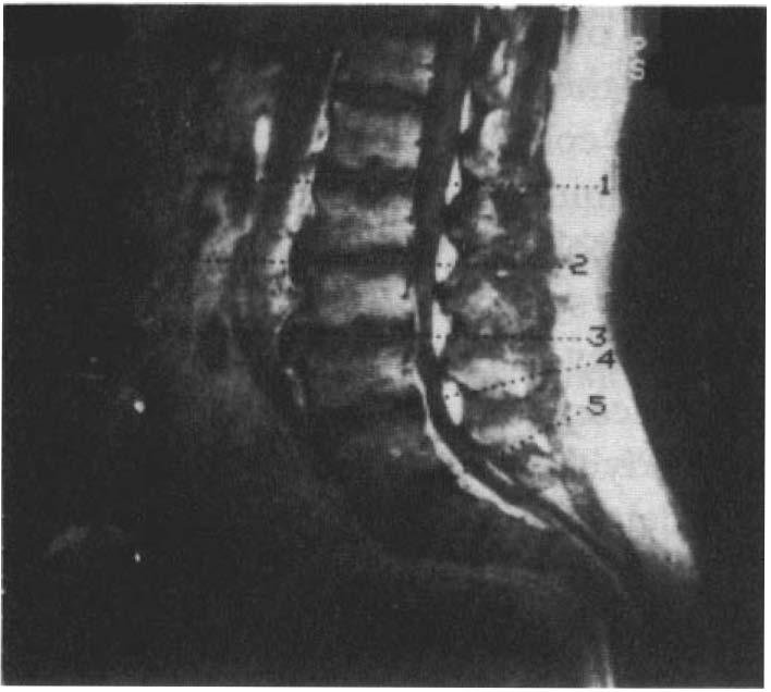 LAURENCE-MOON-BIEDL-BARDET SYNDROME 353 Figure 4 Magnetic resonance imaging of the lumbar spine demonstrating severe spinal stenosis with cord atrophy.