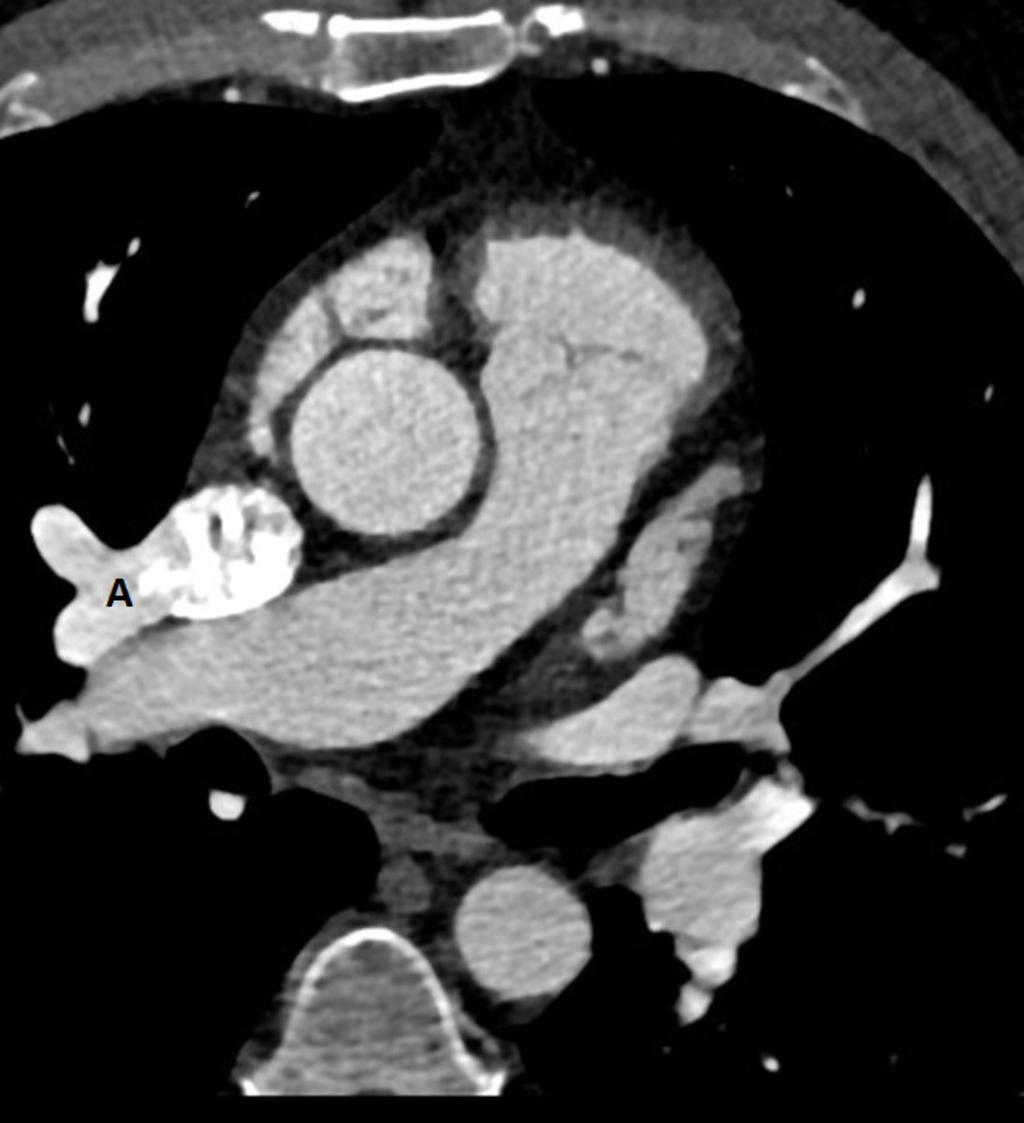 Fig. 4: CTA image demonstrates an anomalous pulmonary