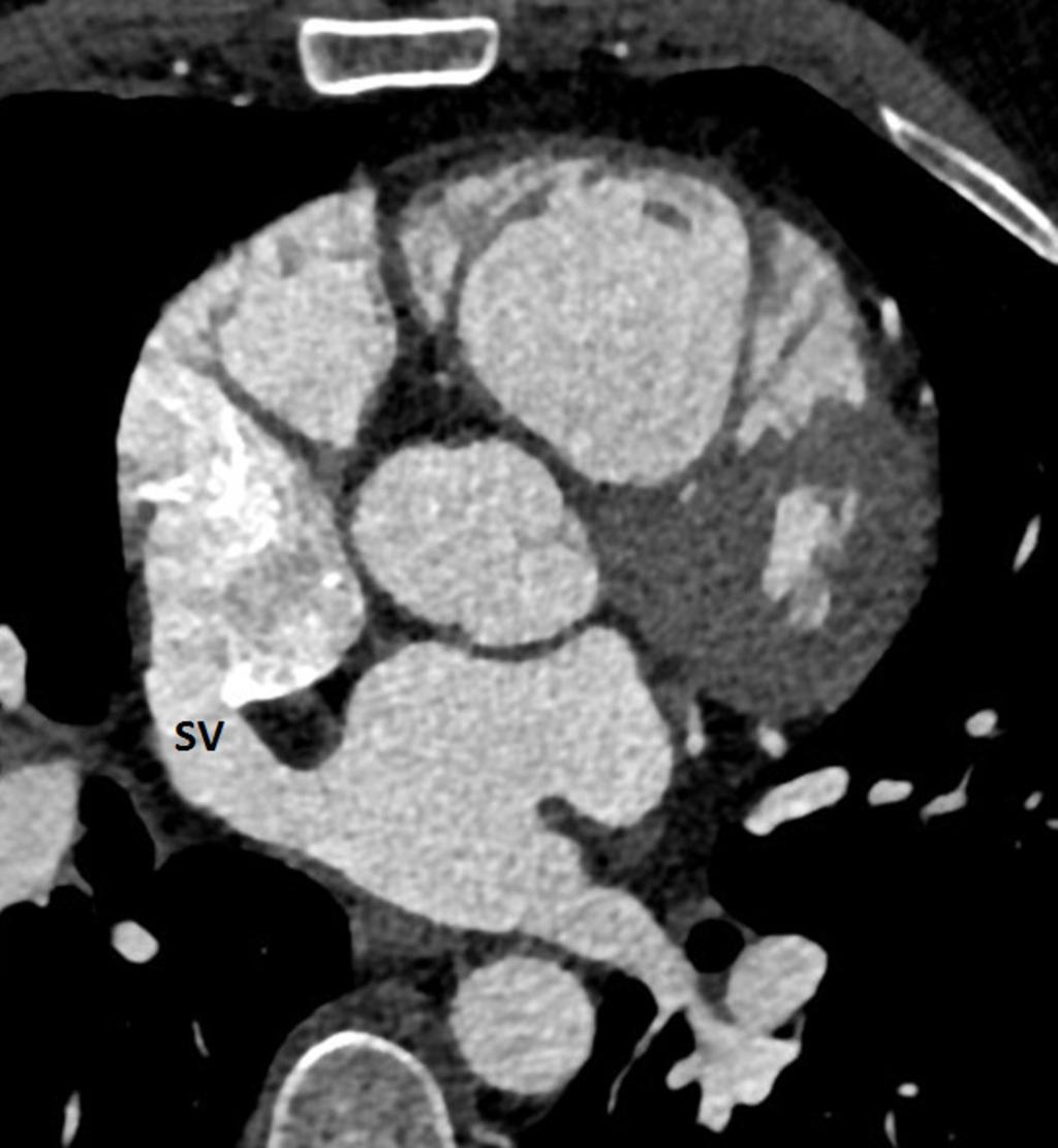 Fig. 5: CTA image at the level of the sinus venosus defect showing free