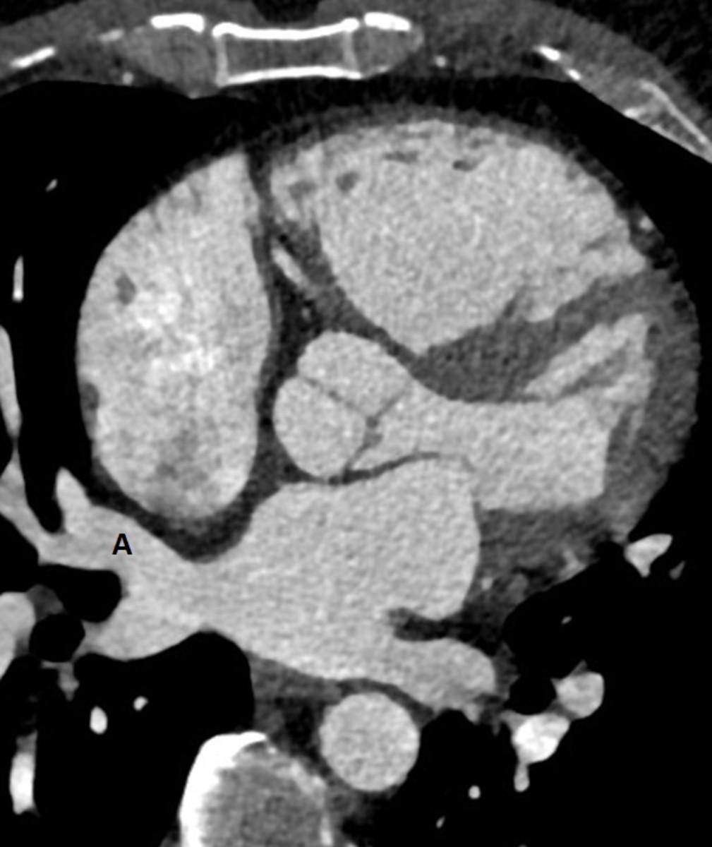 Fig. 6: CTA image more inferiorly demonstrates the drainage of the right middle lobe and right lower lobe pulmonary venous branches into the left