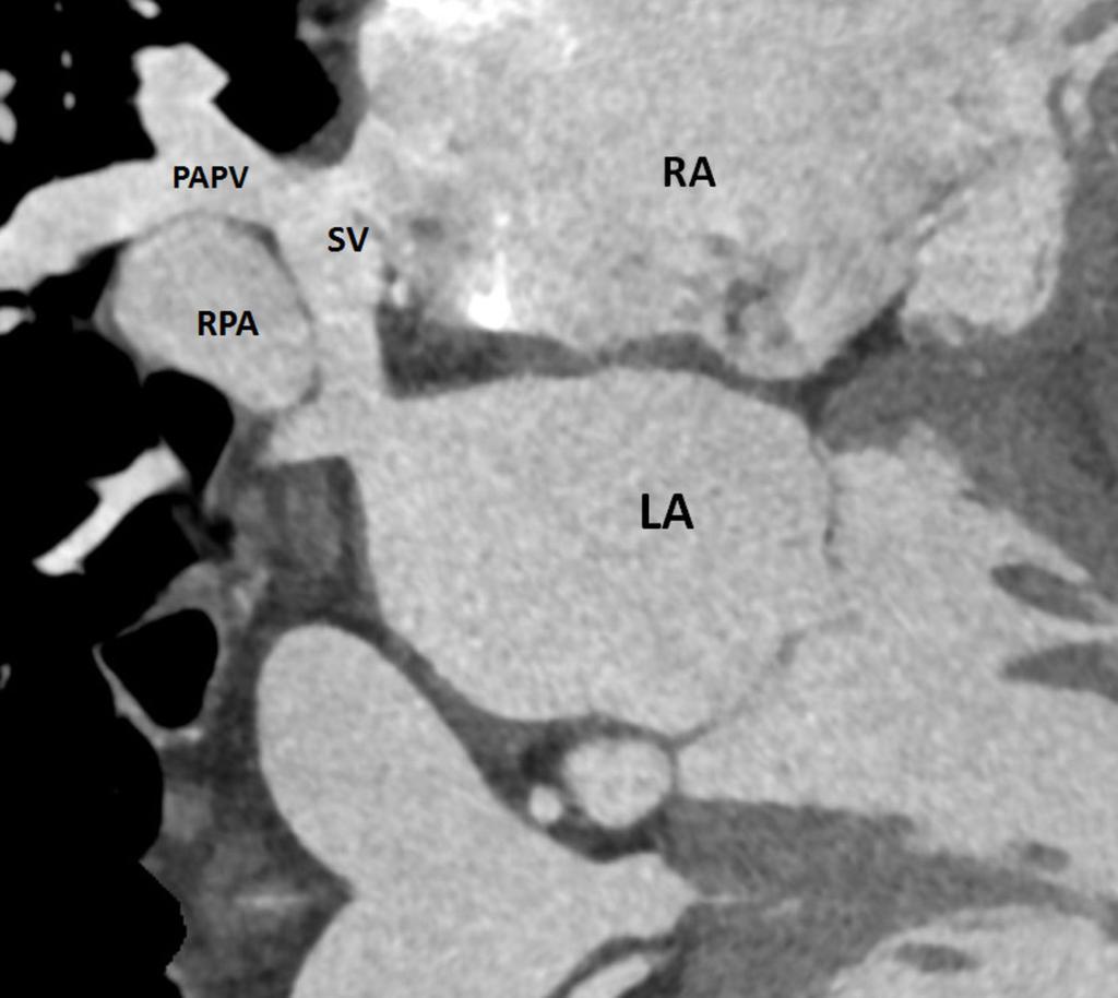 Fig. 7: MIP reconstruction nicely demonstrates the sinus venosus atrial septal defect (SV) and the anomalous