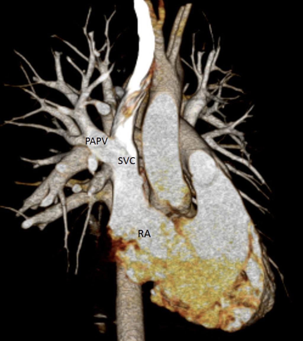 Fig. 9: CTA image in the same patient at a more cephalad level shows the anomalous right superior pulmonary vein (PAPV) draining into the superior vena cava near the junction with the right atrium.