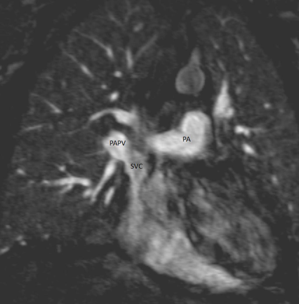 Fig. 13: Coronal MRA image at a slightly different level shows the anomalous