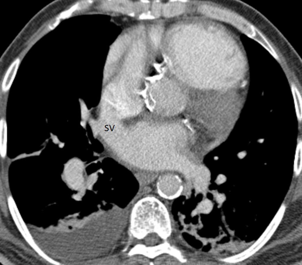Fig. 16: CT chest in this patient shows a