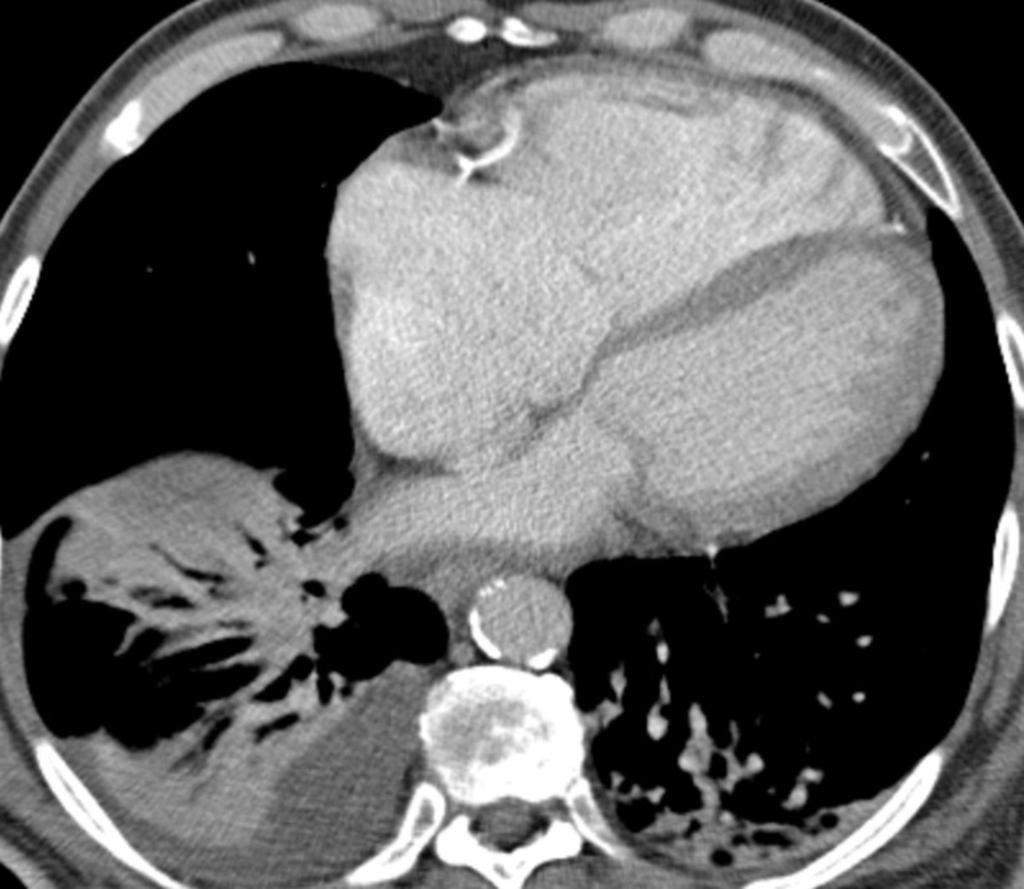 Fig. 17: CT image at the level of the ventricles in the same patient shows severe right atrial and right ventricular enlargement, as well as a small right pleural effusion.