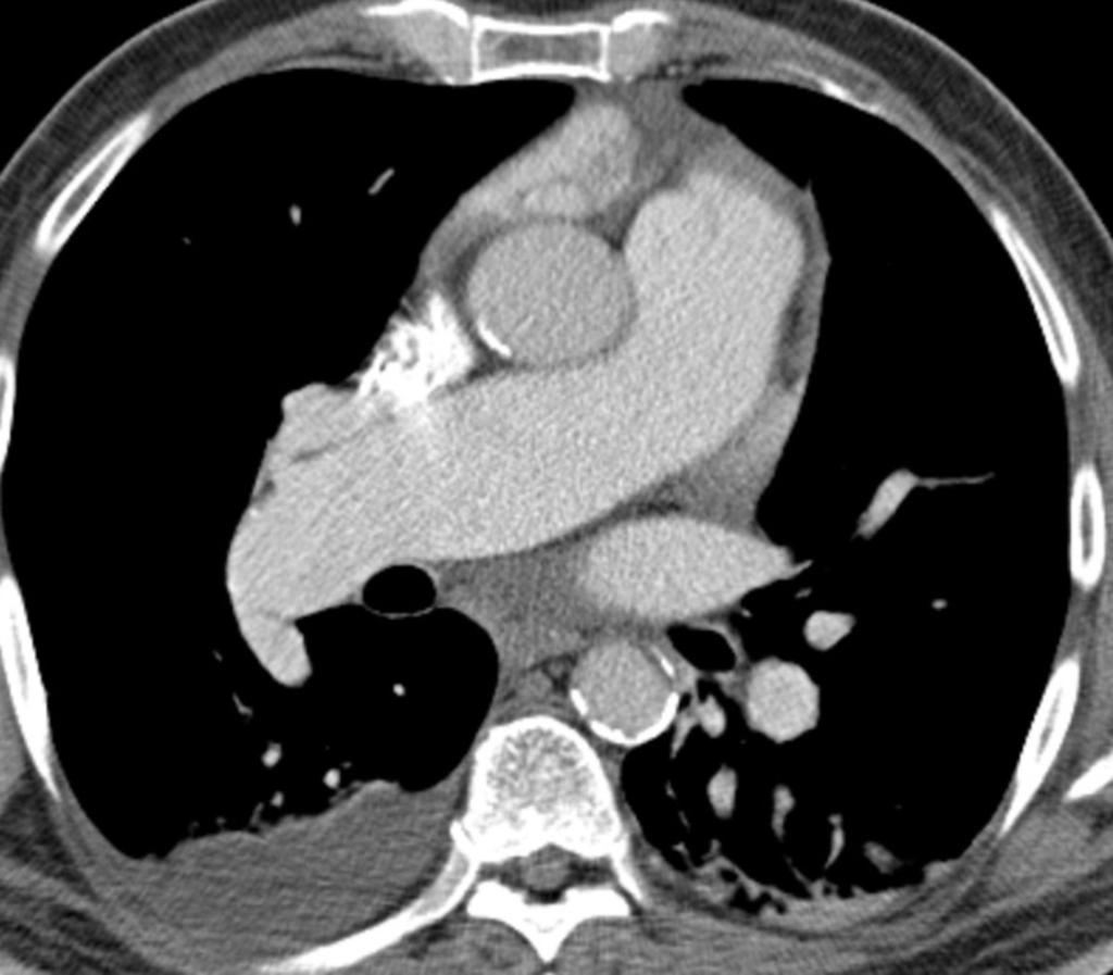 Fig. 18: CT image at the level of the pulmonary artery shows central enlargement of the pulmonary arterial trunk consistent with pulmonary arterial hypertension.