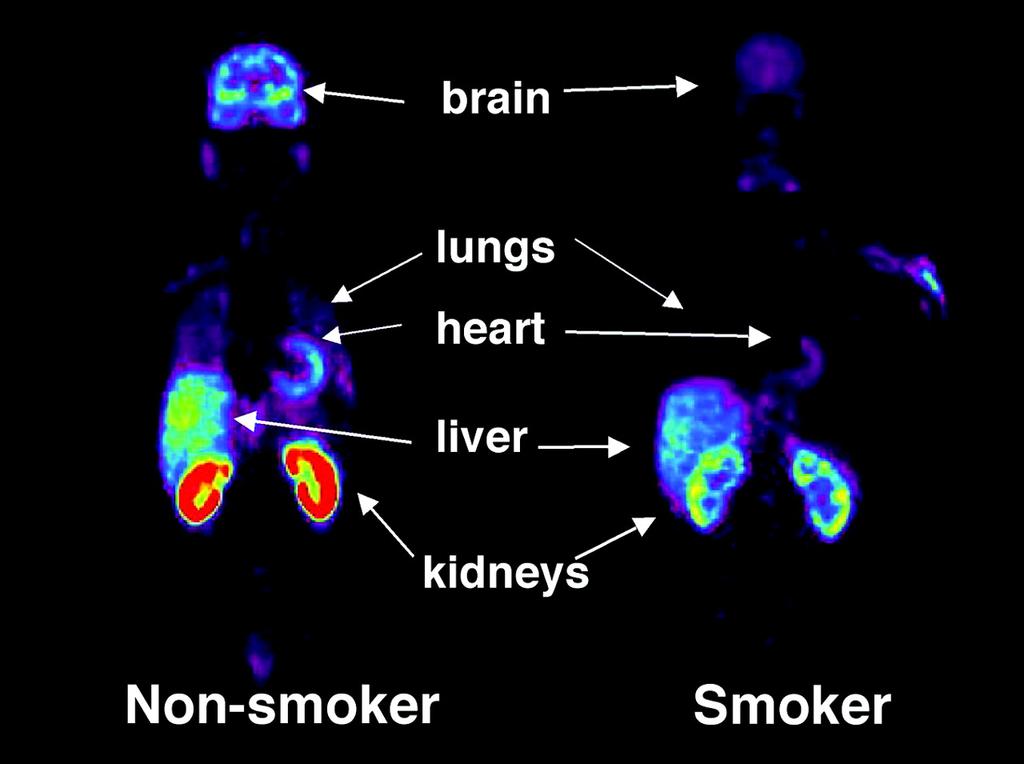 Smoking Effects on MAO-B Activity Fowler, JS et al.